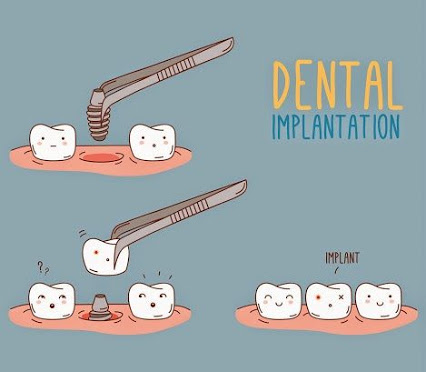Dental Implants In Nanded
